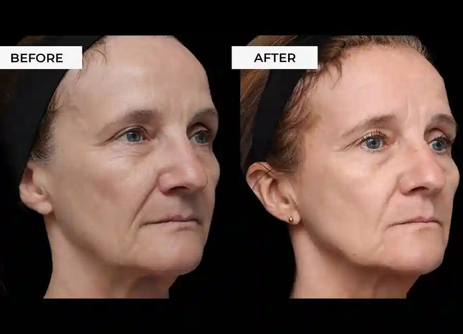 How Many RF Microneedling Sessions Will You Need to See a Difference Crewe?