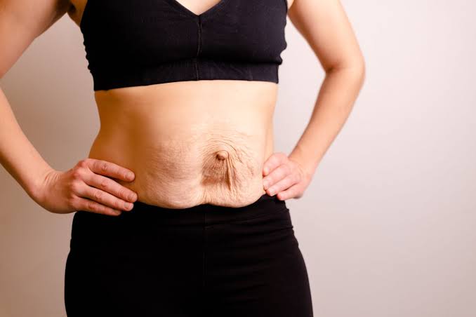 Is Surgery Really the Only Way to Repair Diastasis Recti Crewe?