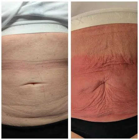 How Does RF Microneedling Improve Crepey, Thin and Uneven Skin Texture Crewe?