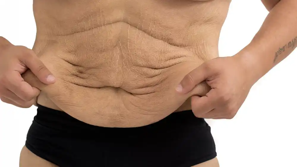 Why Does Weight Loss Medication Leave Some People With Loose or Sagging Skin Crewe?